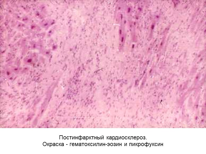 Постинфарктный кардиосклероз. Окраска - гематоксилин-эозин и пикрофуксин